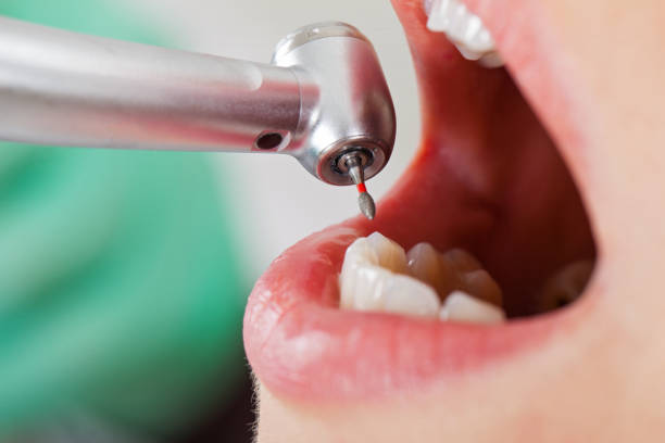 Best Emergency Root Canal Treatment in Greenfield, WI